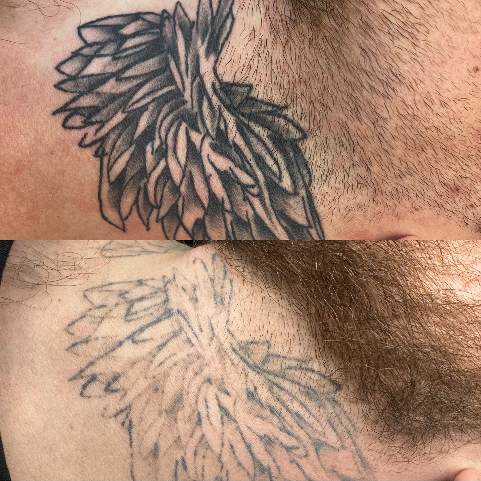 Laser Tattoo Removal website pic 1