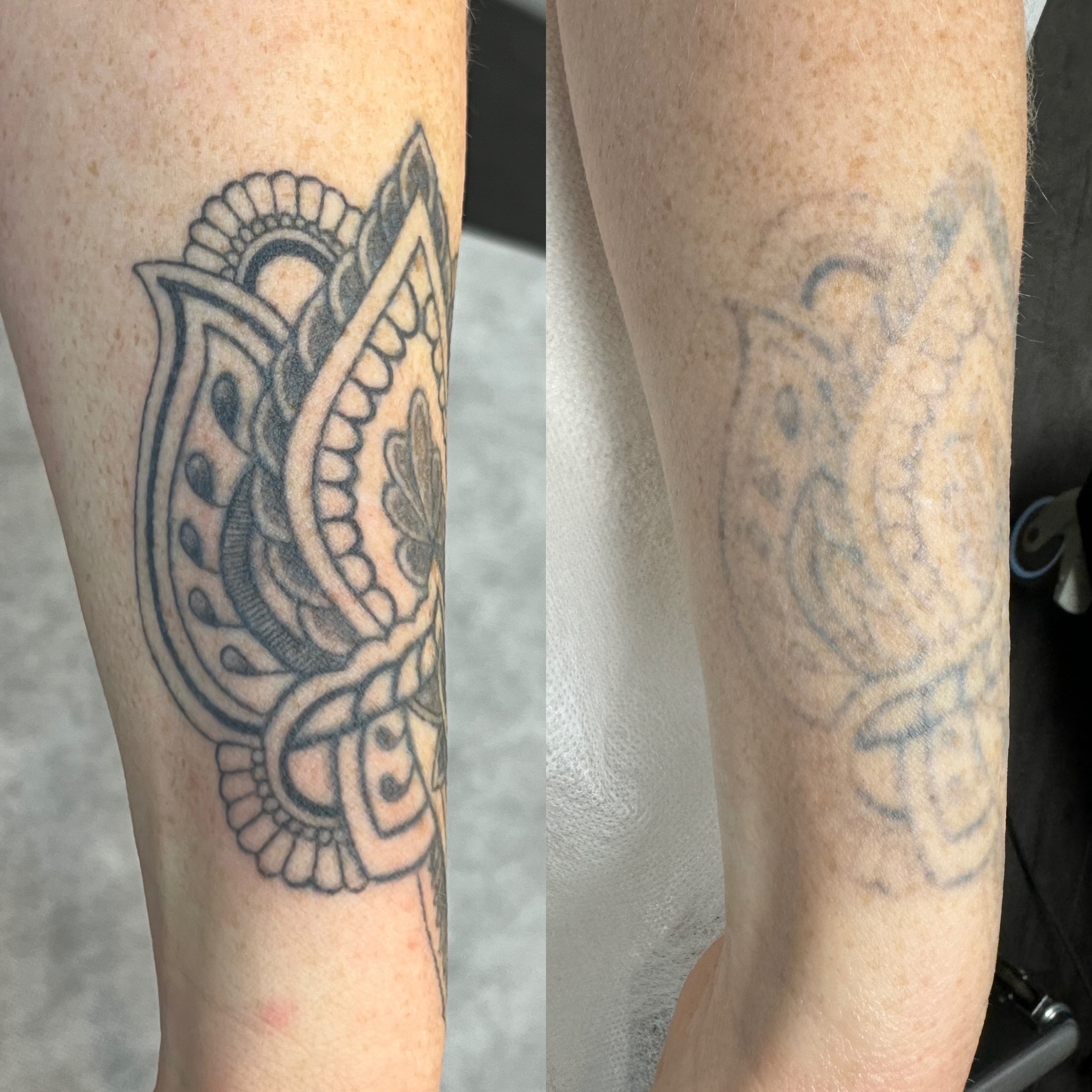 Laser Tattoo Removal website pic 2